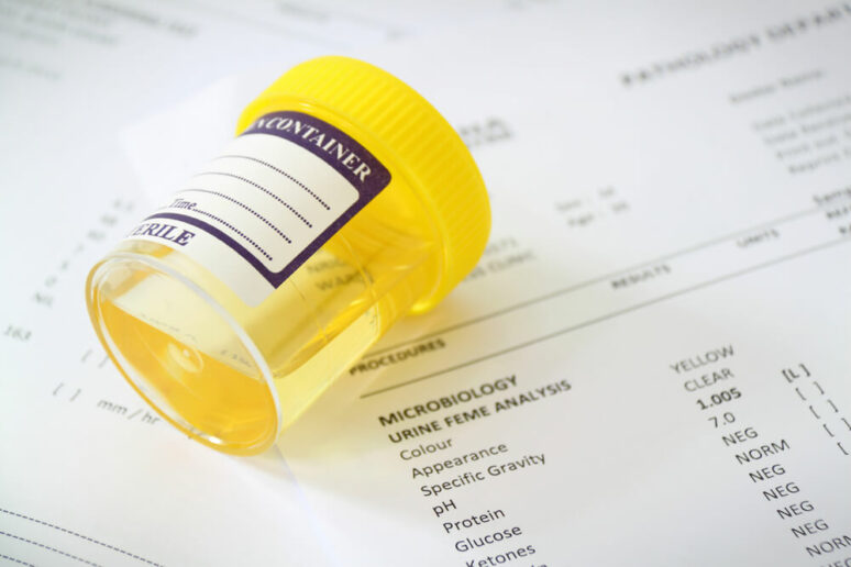 A urine drug test